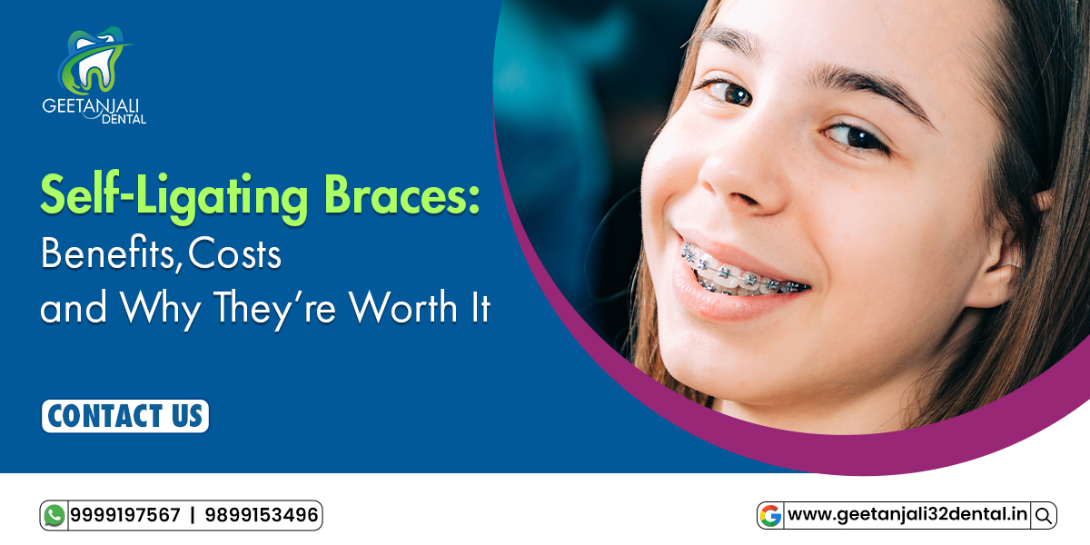 Self-Ligating Braces Benefits, Costs, and Why They’re Worth It.